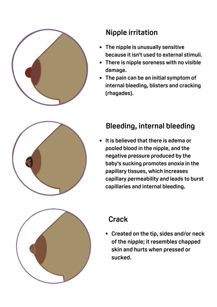 Cracked or Bleeding Nipples While Breastfeeding